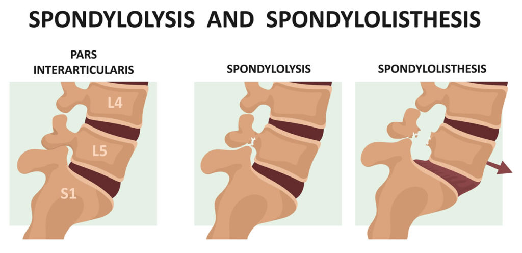 Spondylolysis